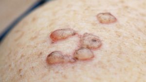 الورم الحليمي 