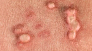 الورم الحليمي