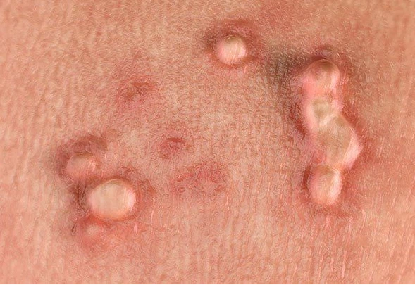 الورم الحليمي