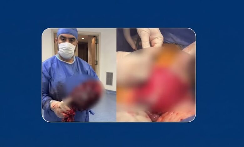جراحة استثنائية تنقذ مريضًا